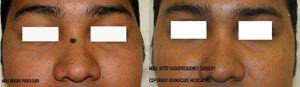 nose mole before and after radiosurgery removal